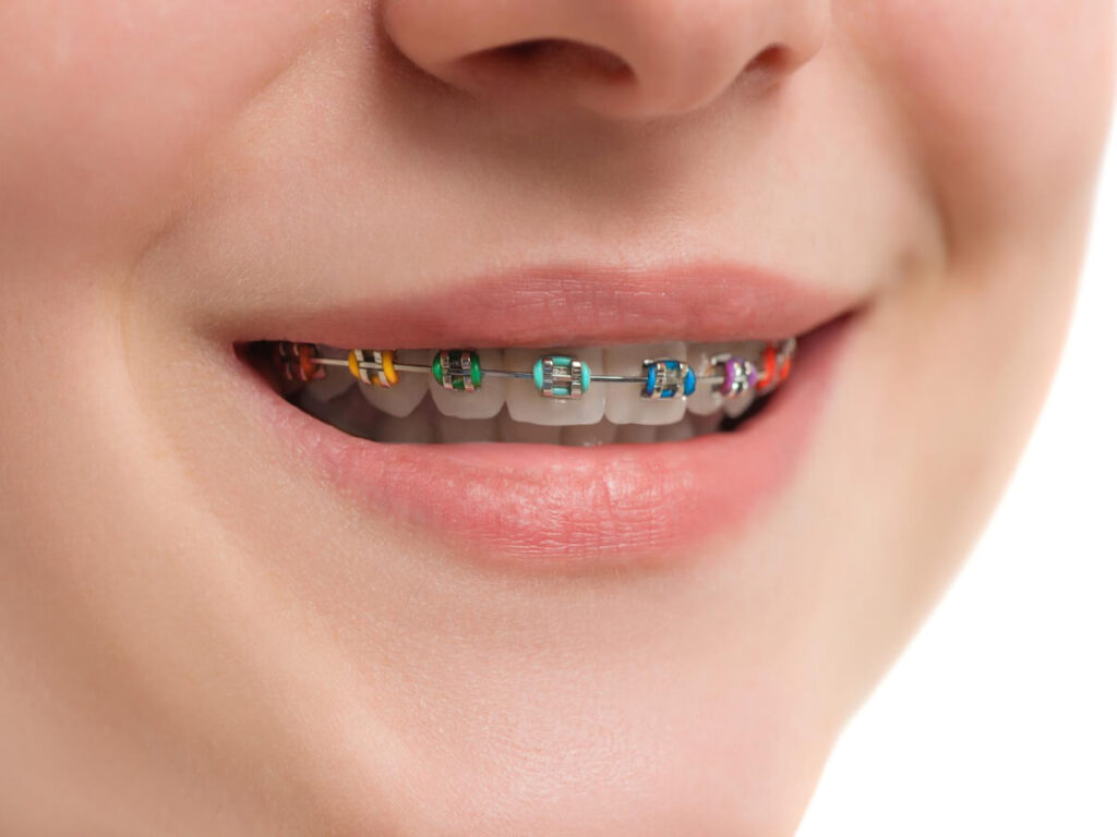 woman wearing conventional or metal braces