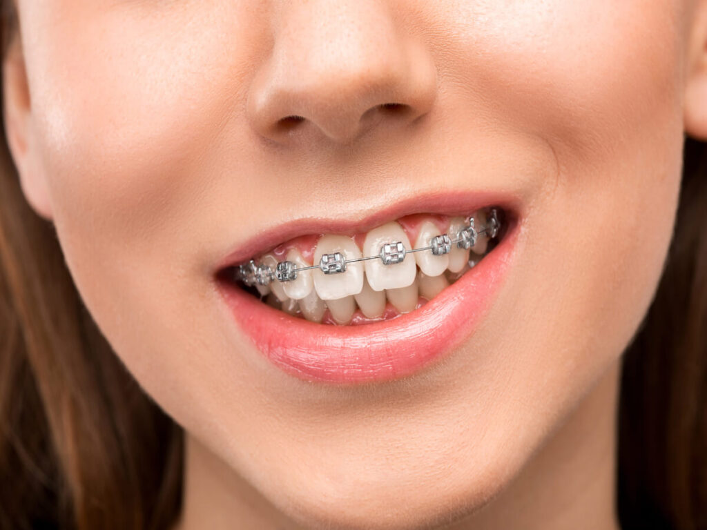 woman wearing self ligating braces