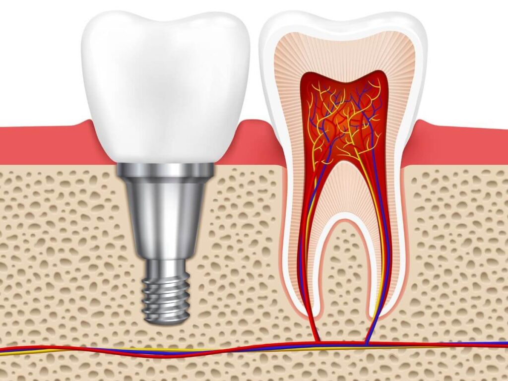 dental implant placement