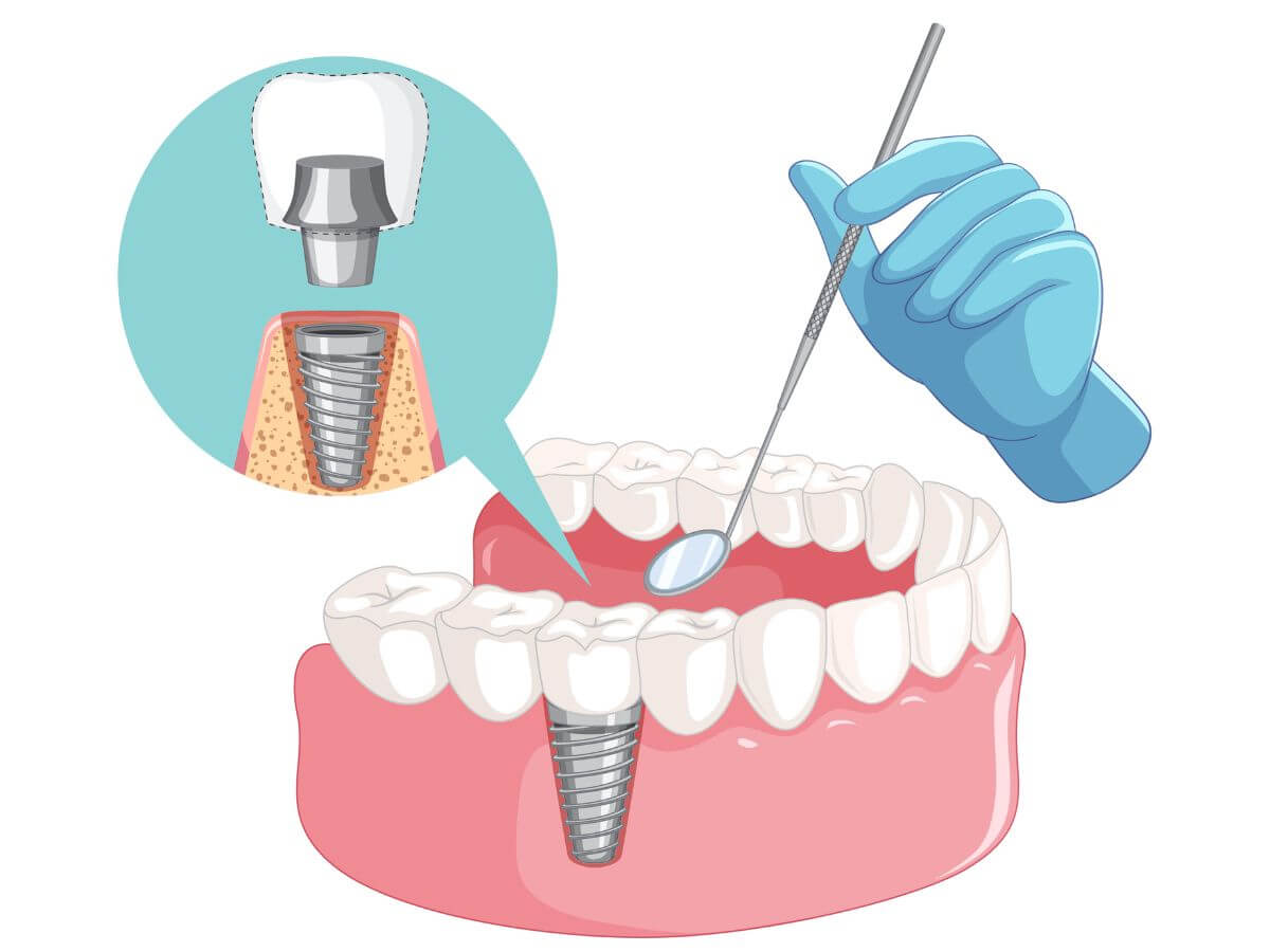 dental implant stages
