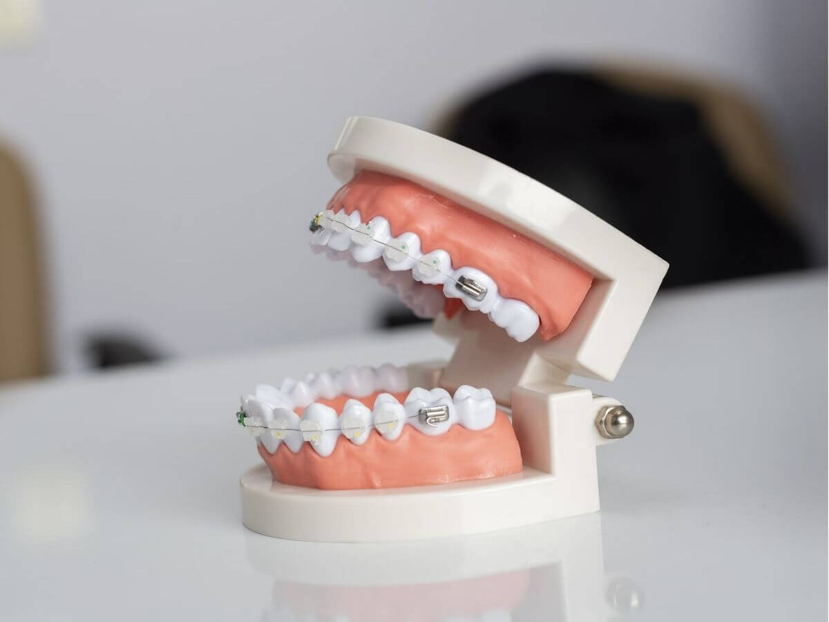 damon ceramic braces