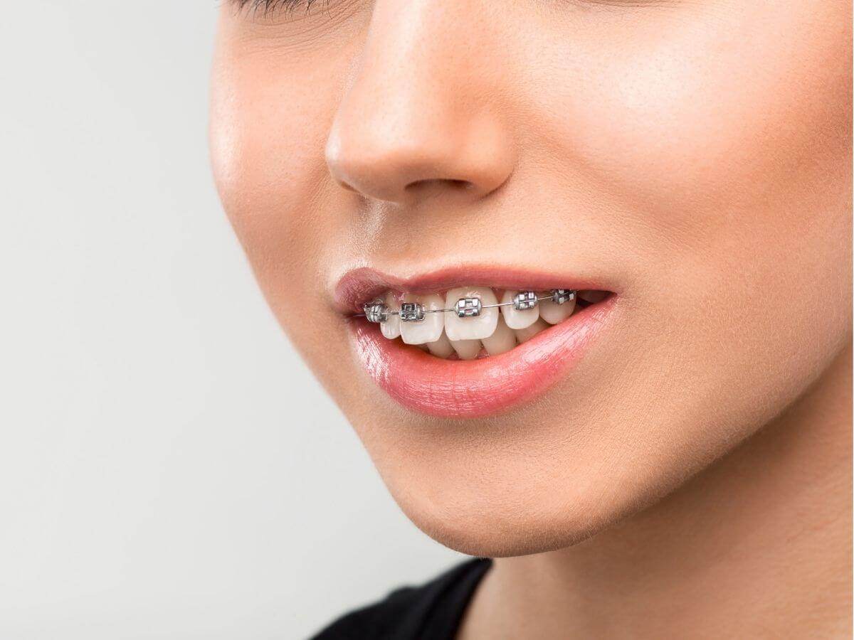 dental braces with damon metal braces