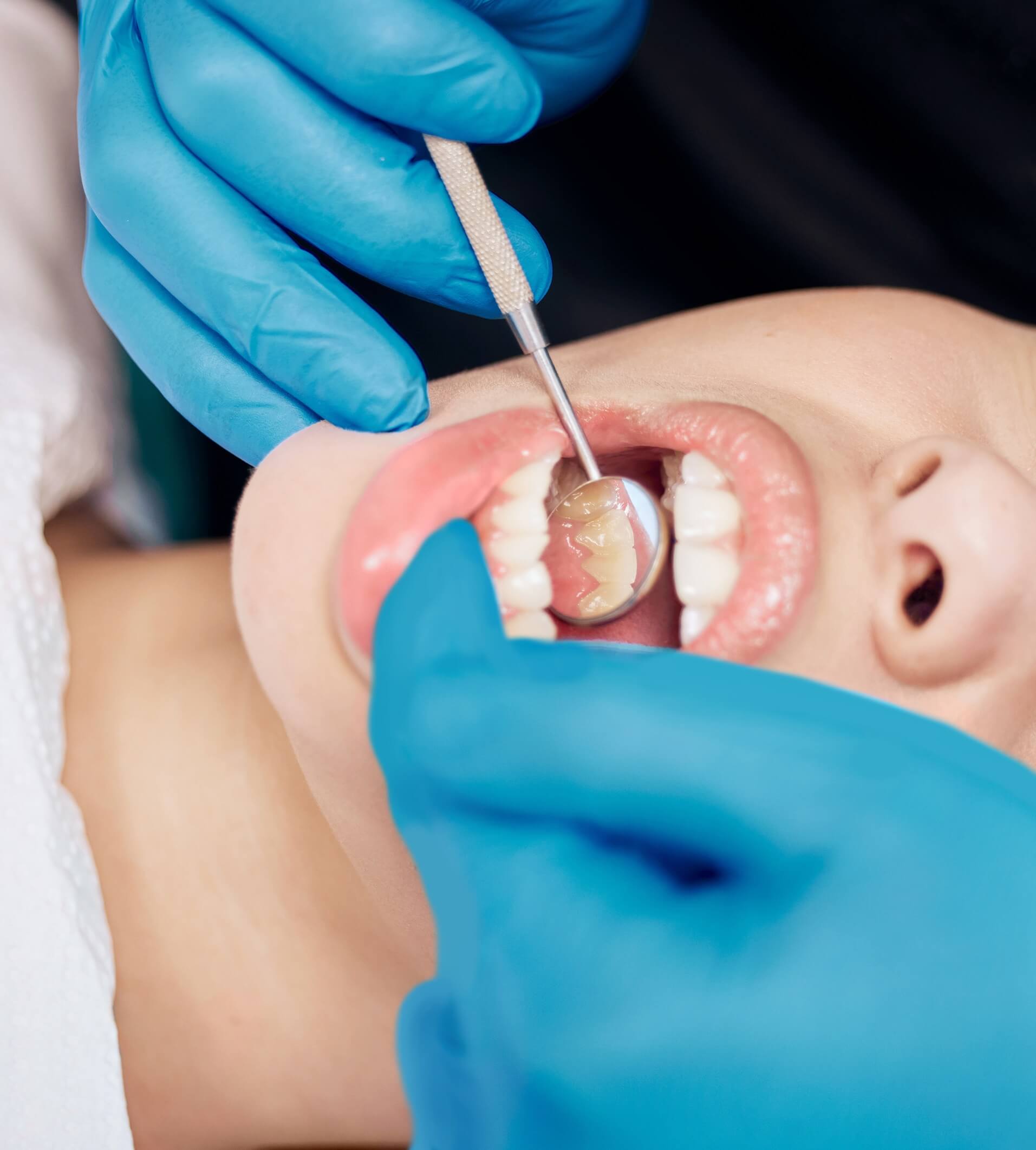 tooth filling gigi bertampal